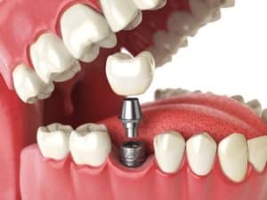 Dental Implant Placement available in Spokane, WA