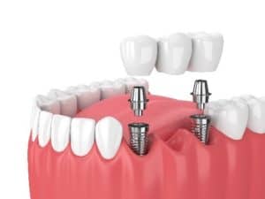 dental bridges with implants Spokane wa