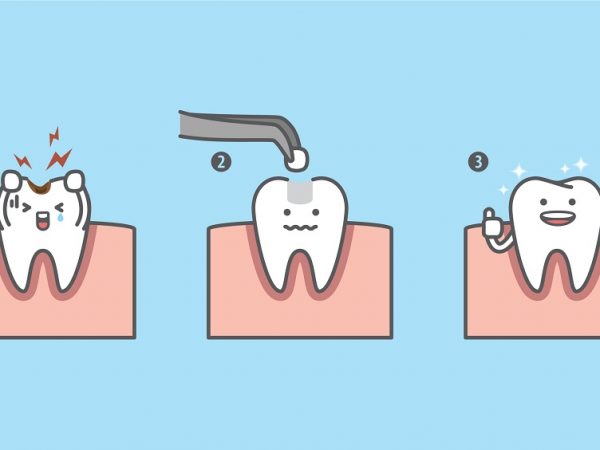 Dental Filling Treatment Process