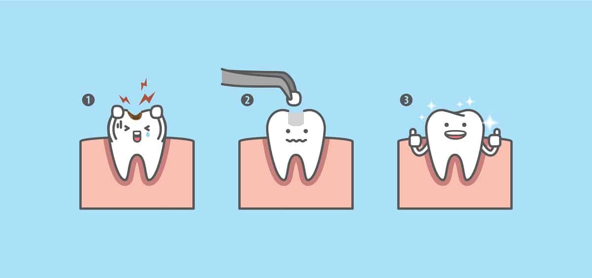 Dental Filling Treatment Process