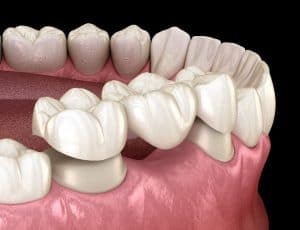 Restorative Dental Bridge Placement