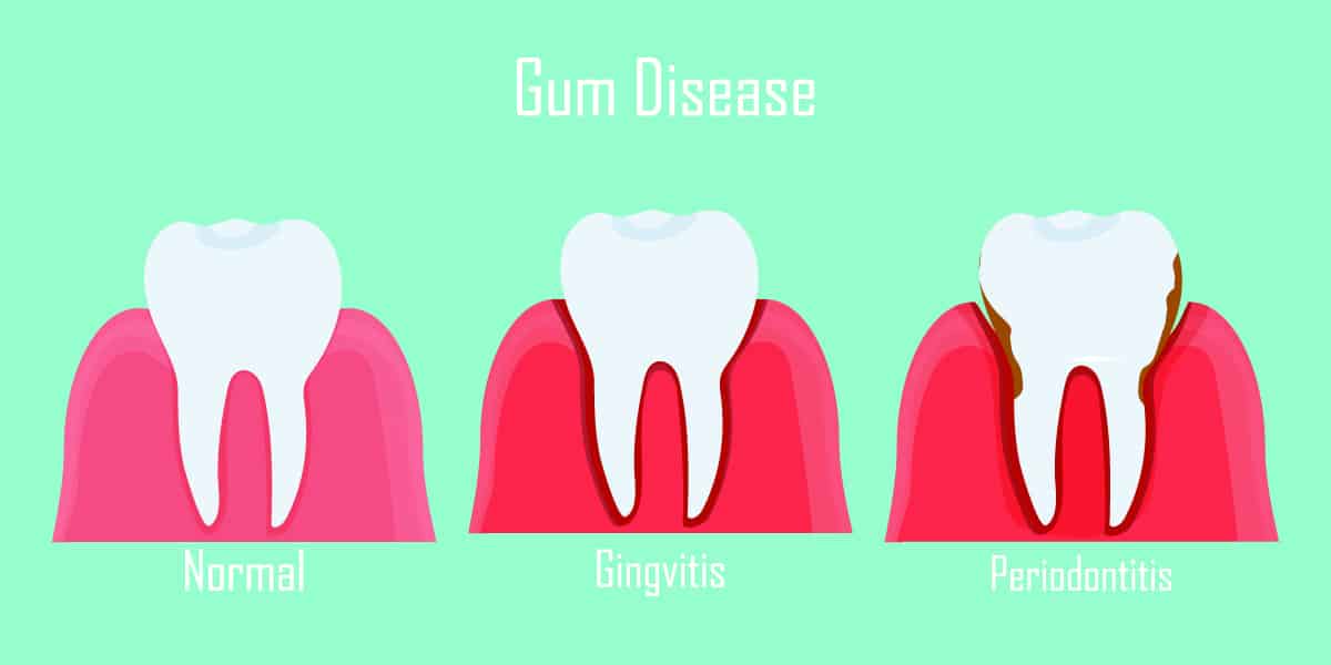 Signs of Advanced Gum Disease Spokane