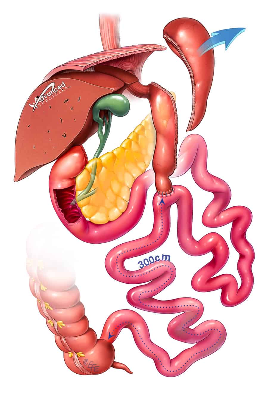 Duodenal Switch Surgery Sydney