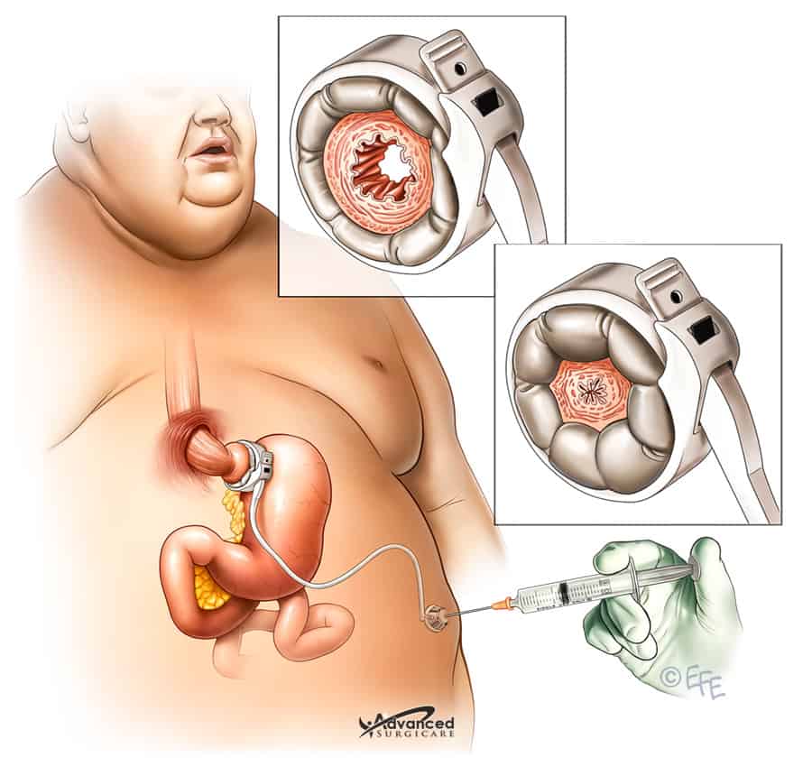 lap-band-surgery-sydney-adjustable-gastric-banding-dr-kuzinkovas