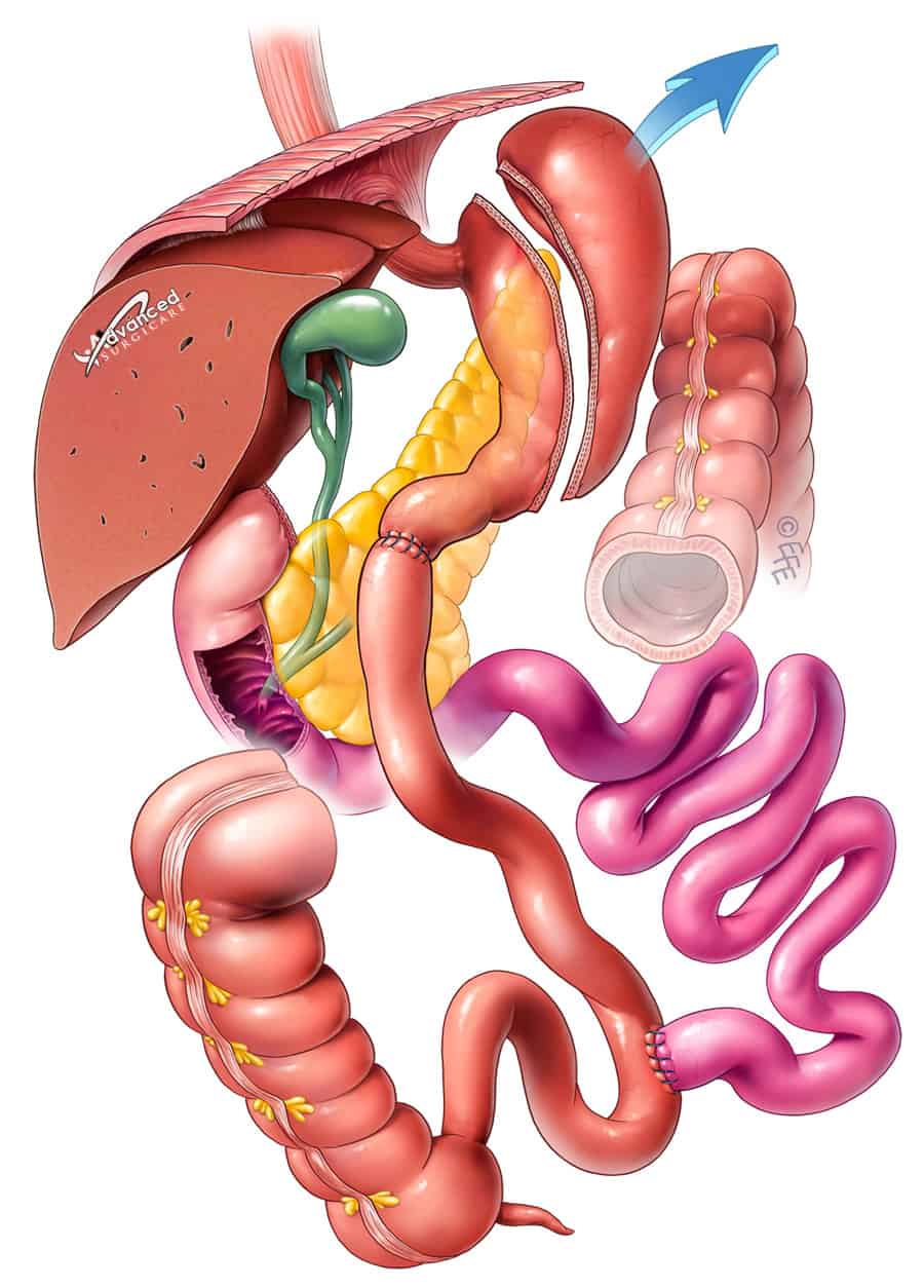 LAP BILIOPANCREATIC DIVERSION SYDNEY