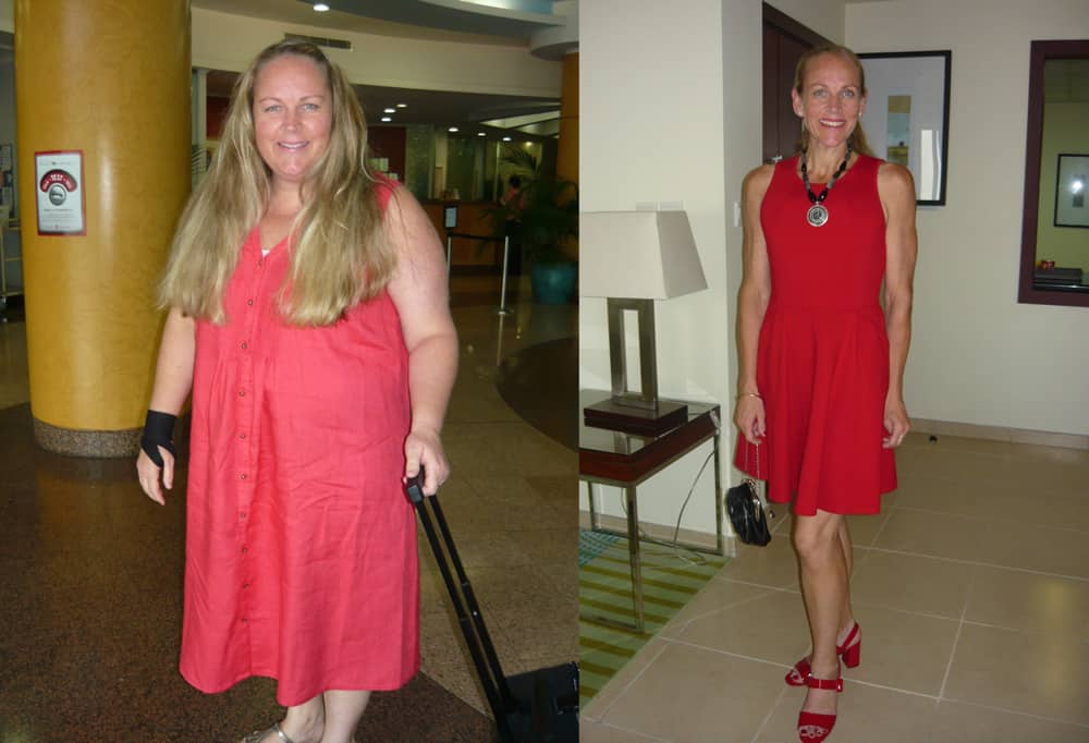 Bariatric Weightloss Surgery Testimonial
