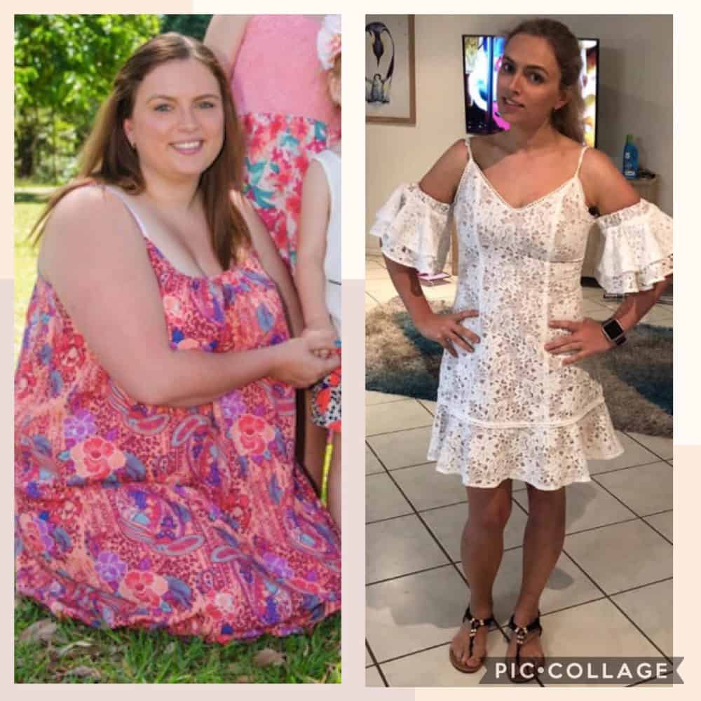 Bariatric Weightloss Surgery Testimonial