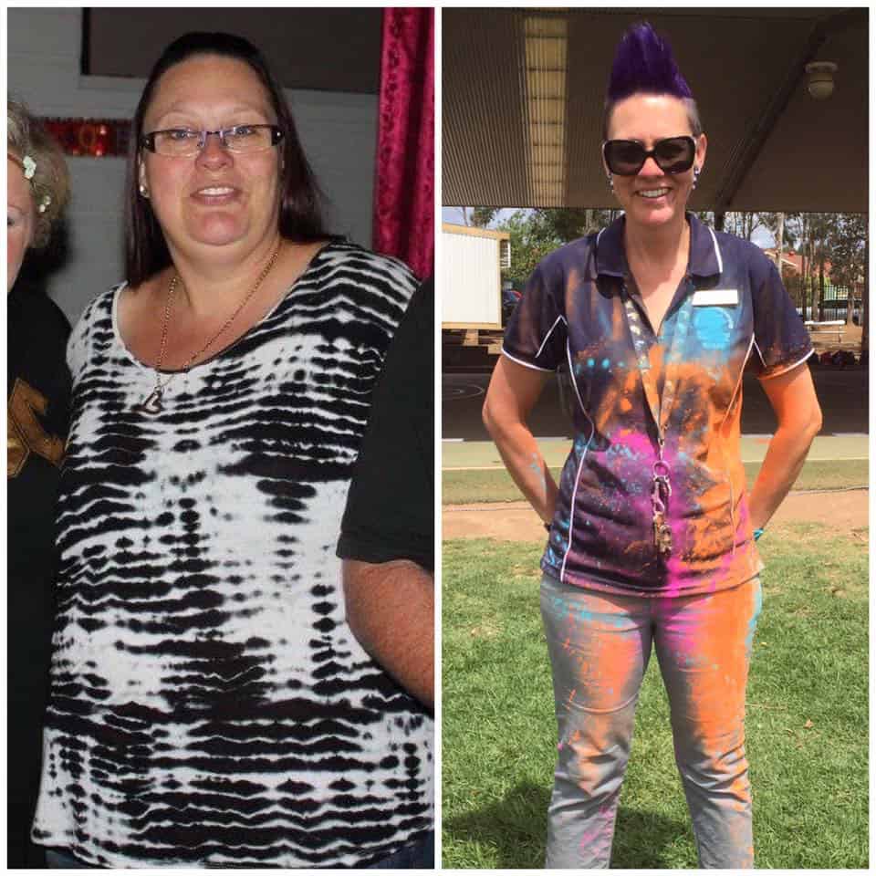 Bariatric Weightloss Surgery Testimonial