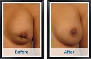 Breast Implant Revision Before and After Photos