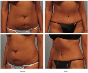 Abdominoplasty Surgery Atlanta, Tummy Tuck