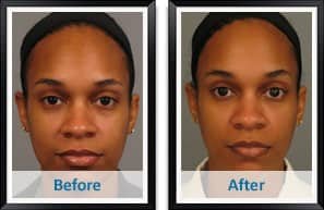 Facial Fat Transfer in Atlanta