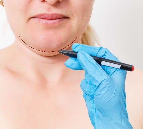 Chin Augmentation in Atlanta