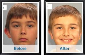 Otoplasty Before and After Photos in Atlanta