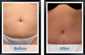 Liposuction Before and After Patient photos