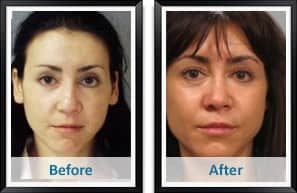 Cheek & Chin Augmentation Before and After Photos