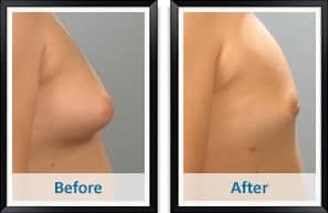 Male Breast Reduction in Atlanta