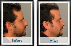 Male Rhinoplasty Patient Photos