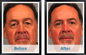 Male Eyelid Surgery Before and After Photos in Atlanta
