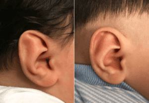 Ear Correction in Atlanta