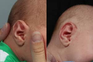 EarWell Patient Before and After Photos
