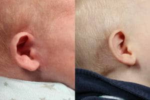 Atlanta Ear Correction Patient Photos