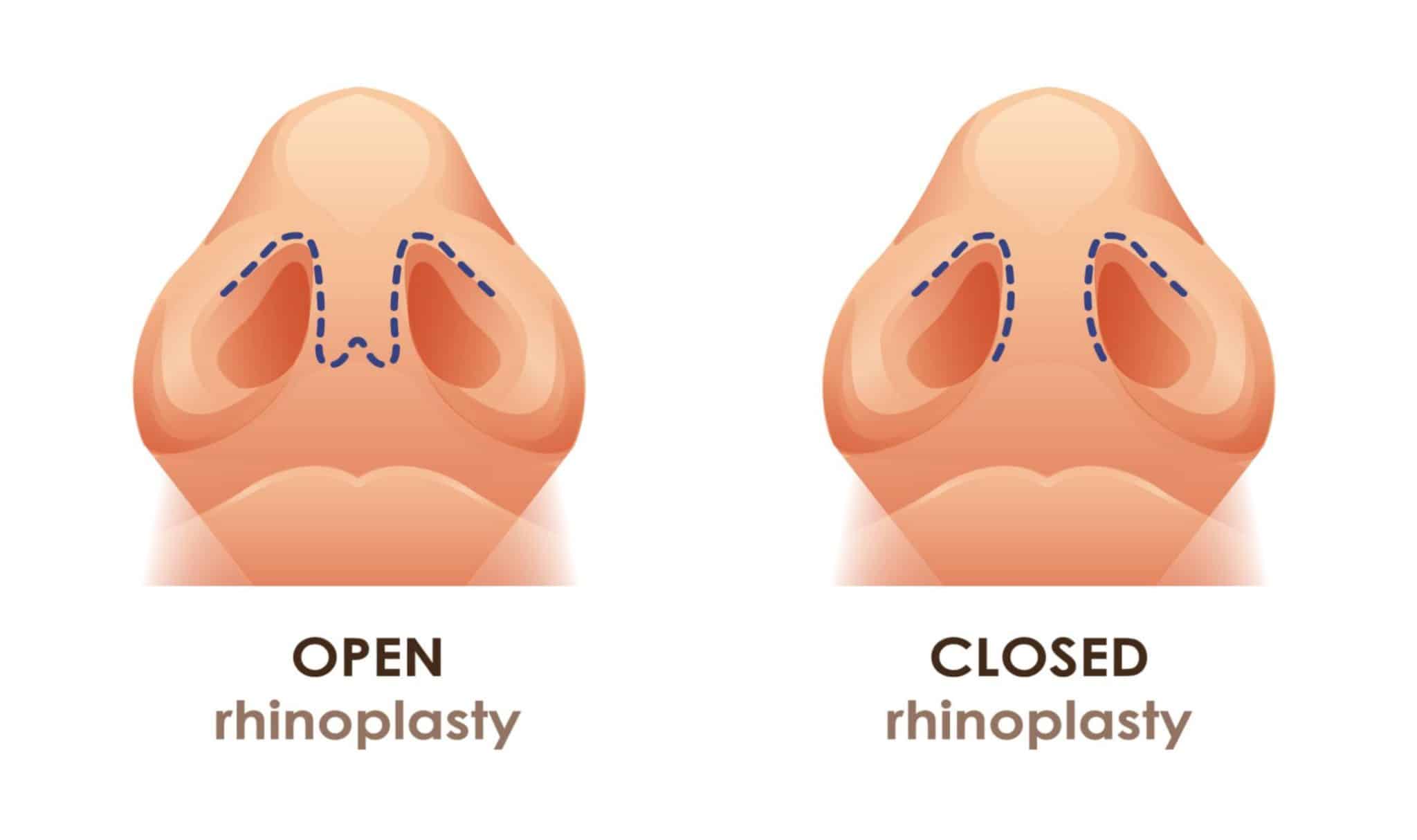 What Is the Difference Between Open and Closed Rhinoplasty