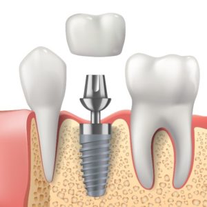 Dental Implant Procedure Details