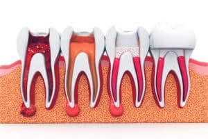 Root Canal Illustration