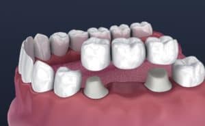 Dental Bridges Beaumont TX Implant Supported Bridges