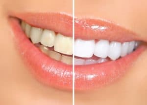 Teeth Whitening for Beaumont & Port Arthur, TX