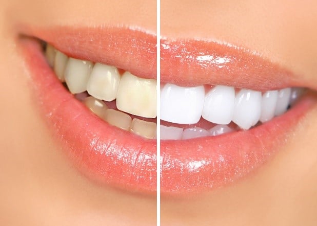 Teeth Whitening Beaumont TX Cosmetic Dentist Port Arthur