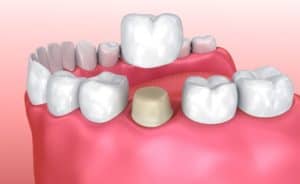Tooth Crowns in Beaumont, TX