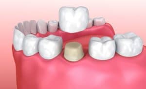 Dental Crowns Beaumont TX Cosmetic Crowns Port Arthur