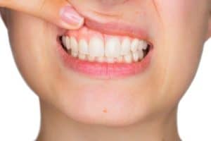 Gum Disease Treatment in Beaumont, TX