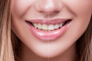 Teeth Whitening in Beaumont, TX