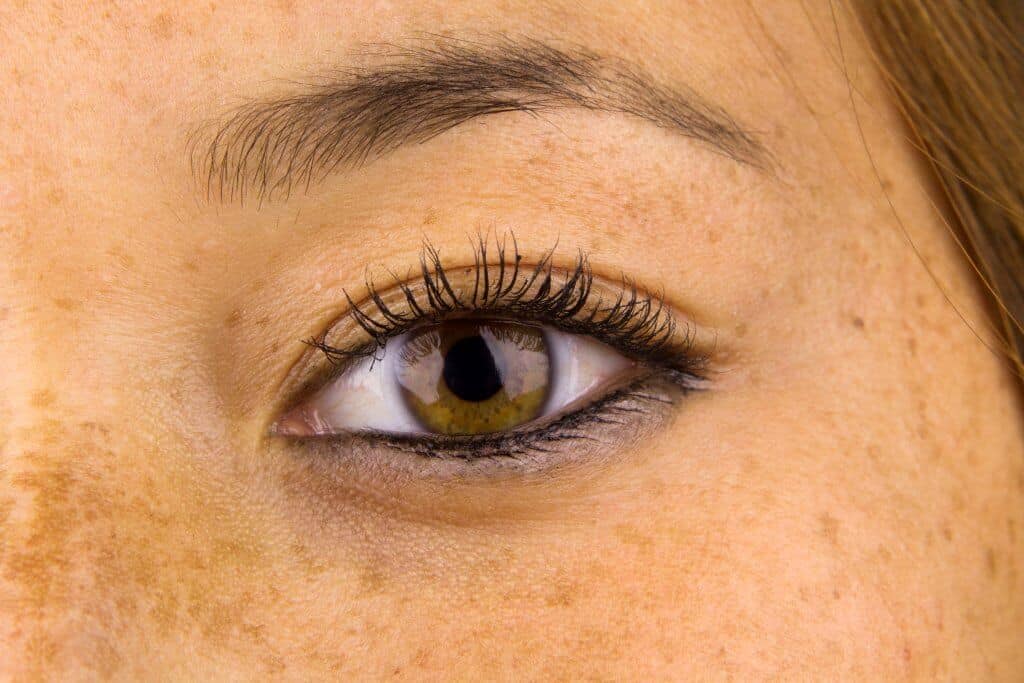 Over exposure to UV damage from the sun can cause permanent pigmentation, or 'sun spots' on your skin.