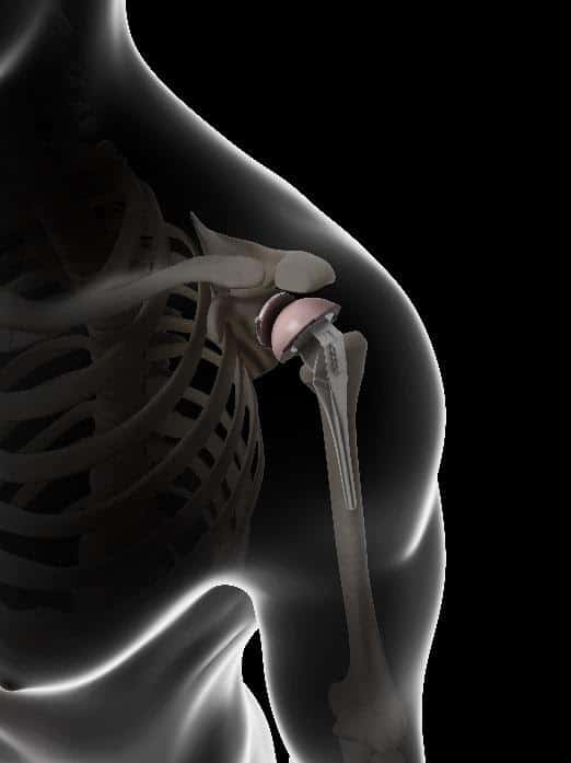 Revision Shoulder Surgery for Columbus & Grove City, OH