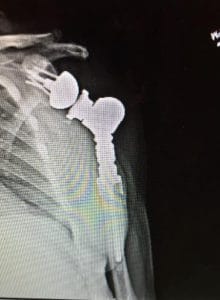 Shoulder X-Ray