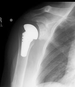 Total Shoulder Replacement X-Ray