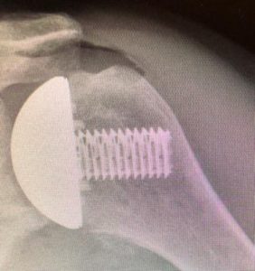 Partial Shoulder Replacement X-Ray