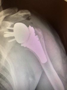 Reverse Shoulder Replacement X-Ray