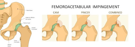 Types of Hip (Femoroacetabular) Impingement