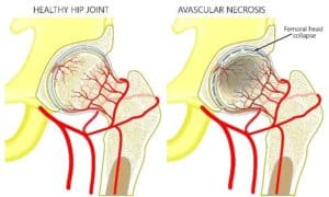 Avascular Necrosis (AVN) Infographic