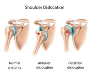 Types of Shoulder Dislocation