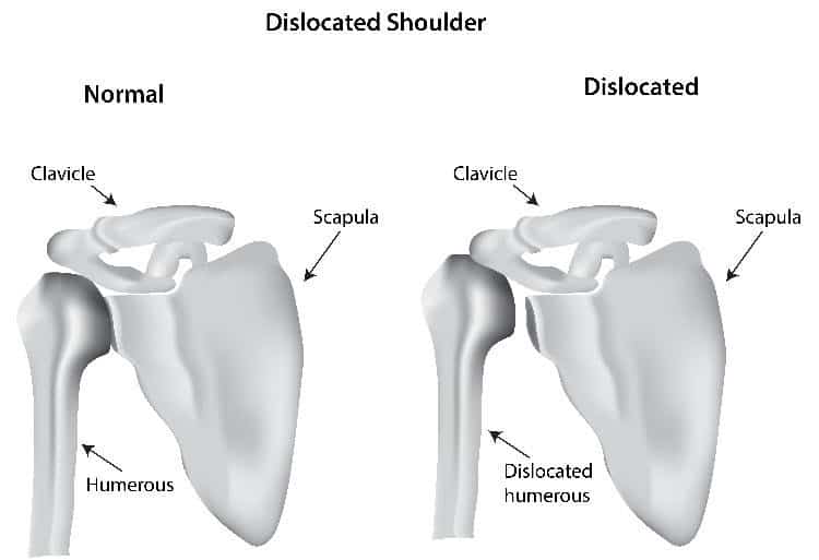 Dislocated Shoulder Treatment for Columbus & Grove City, OH