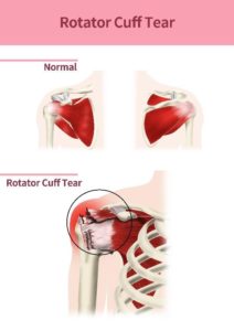 Rotator Cuff Diagram (healthy and injured)