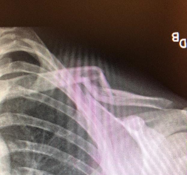 Clavicle Fracture X-Ray