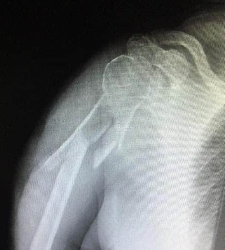 Shoulder Fracture X-Ray