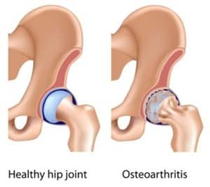 Hip Arthritis Illustration