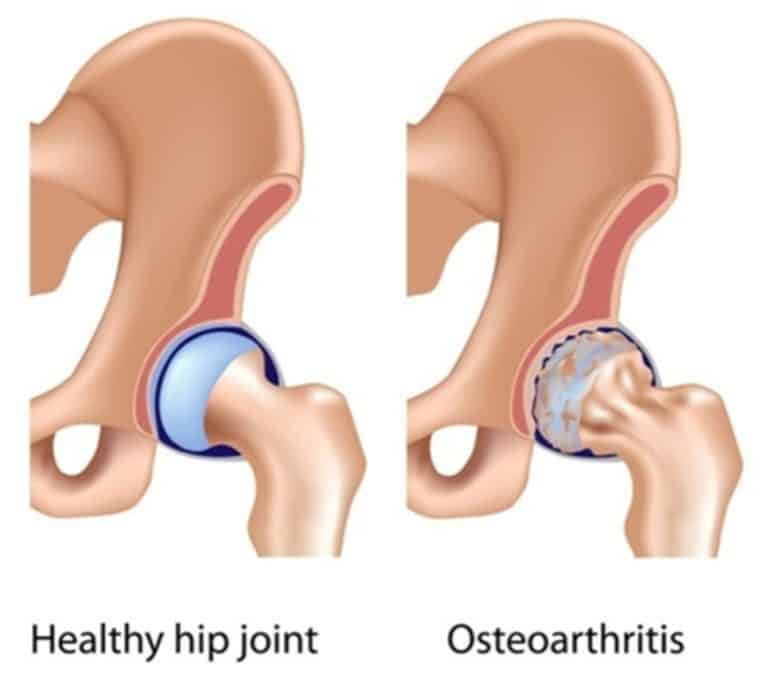 Hip Arthritis Treatment Chillicothe, OH Hip Osteoarthritis Care